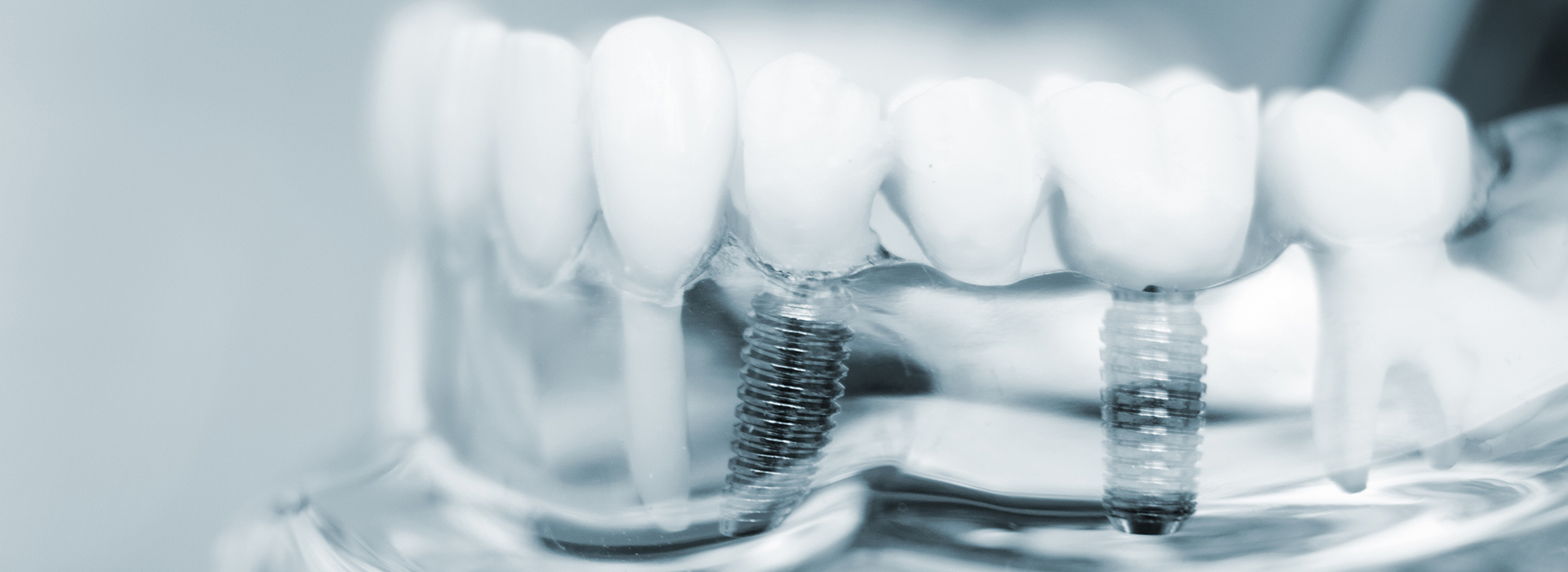 Associates in Dentistry | Implant Restorations, Aesthetic Tooth Colored Fillings and Root Canals