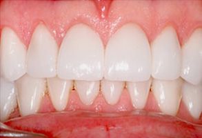 Associates in Dentistry | Veneers, Implant Restorations and TMJ Disorders